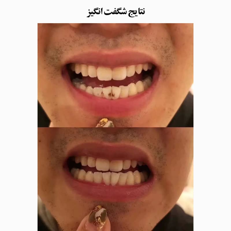 دستگاه جرم گیر دندان شارژی کروی مون مدل sonicare - Image 22