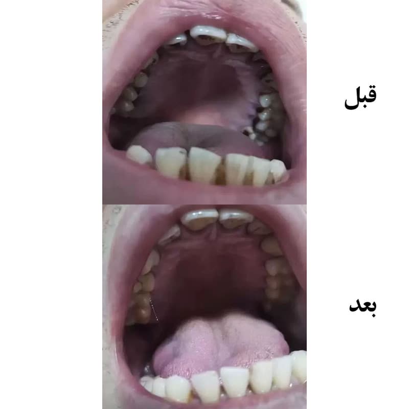 دستگاه جرم گیر دندان شارژی کروی مون مدل sonicare - Image 23