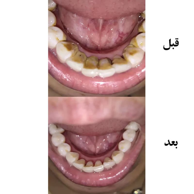 دستگاه جرم گیر دندان شارژی کروی مون مدل sonicare - Image 24